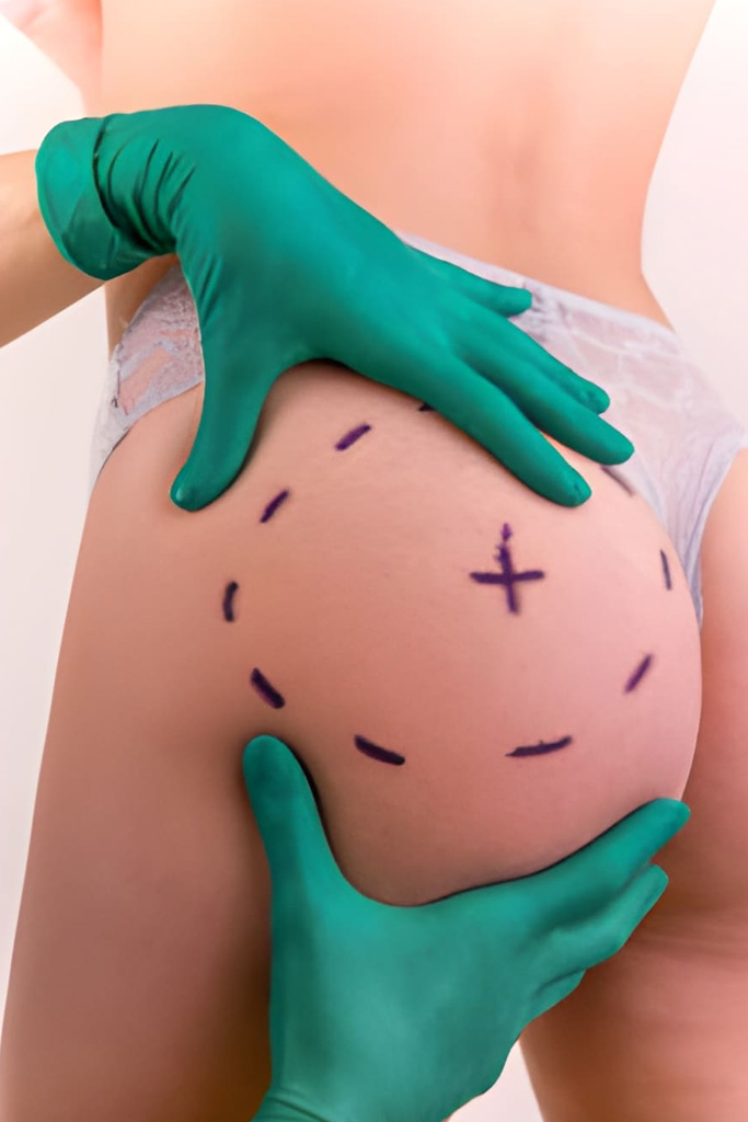 Augmentation des fesses