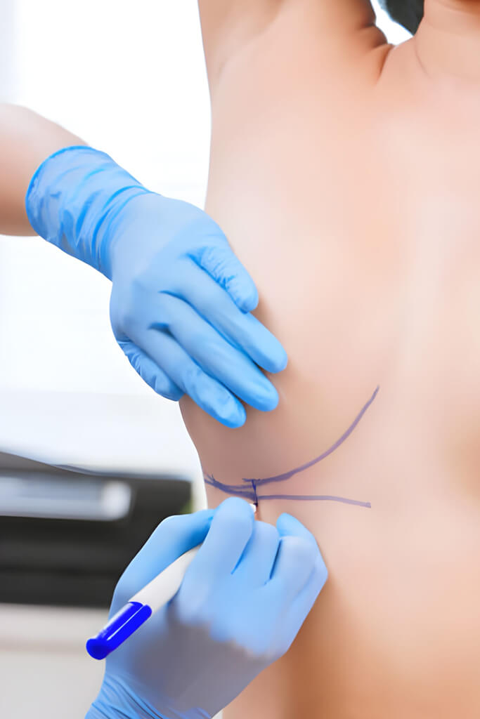 Augmentation mammaire