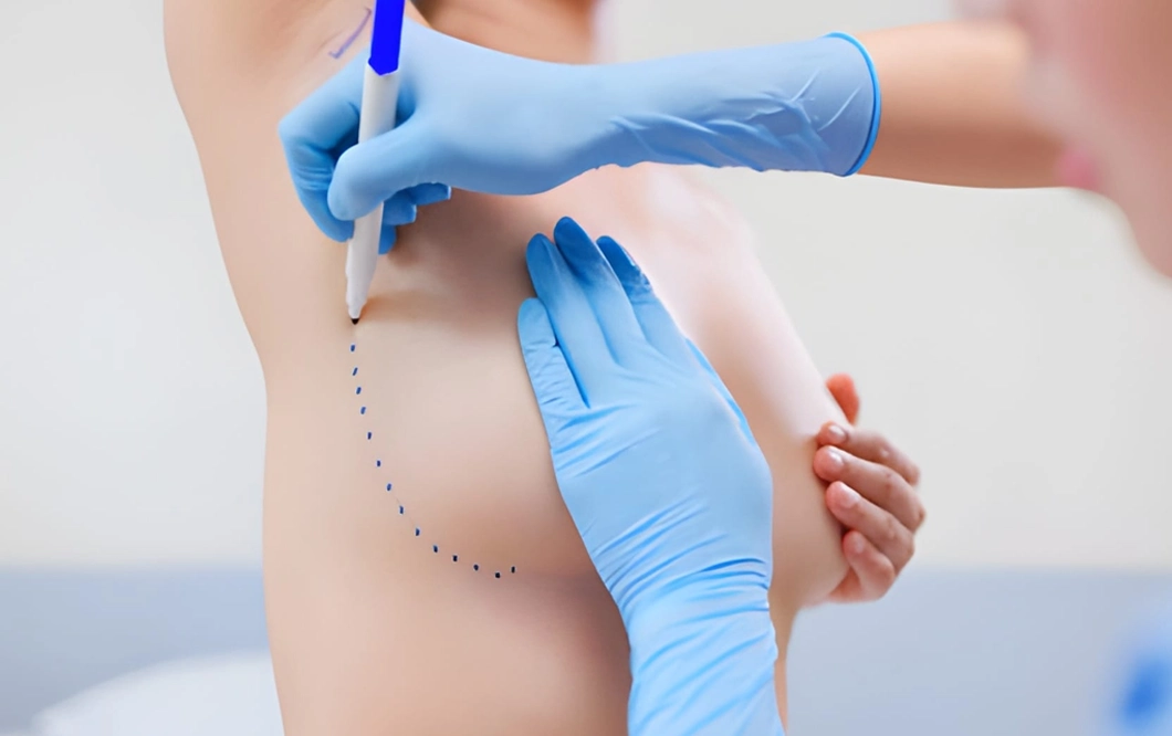 augmentation mammaire